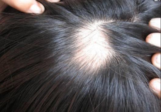 头皮有这四个怪相，大多是螨虫正在堵塞毛囊，两招螨虫被清空