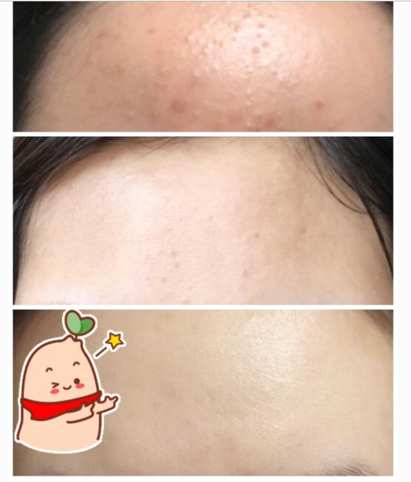 清理粉刺闭口后怎么护肤好点,如何去闭口粉刺最有效的方法