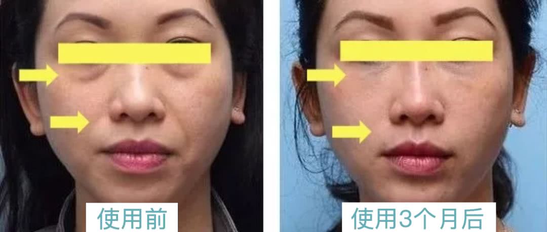 号称“1小时逆龄10年”的微整？我亲身体验了