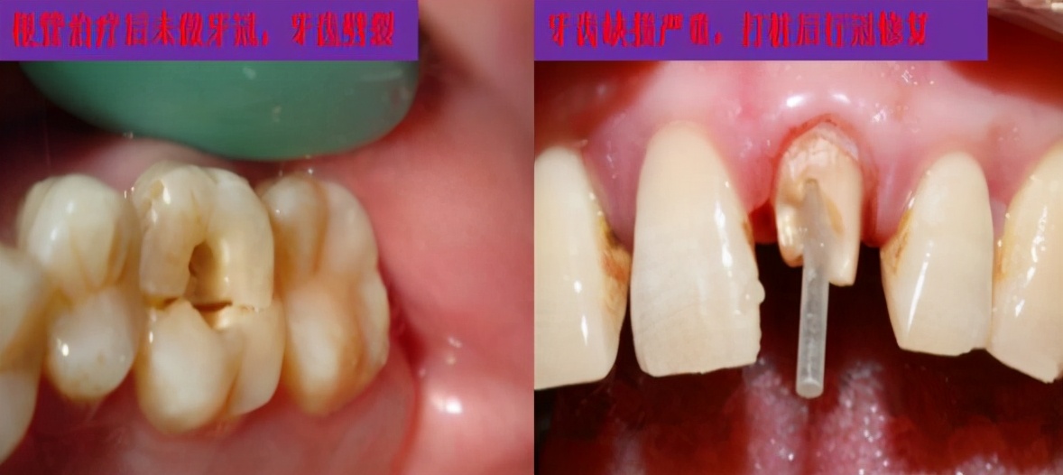 18岁女孩牙齿磨了,门牙是烤瓷牙可以矫正牙齿吗