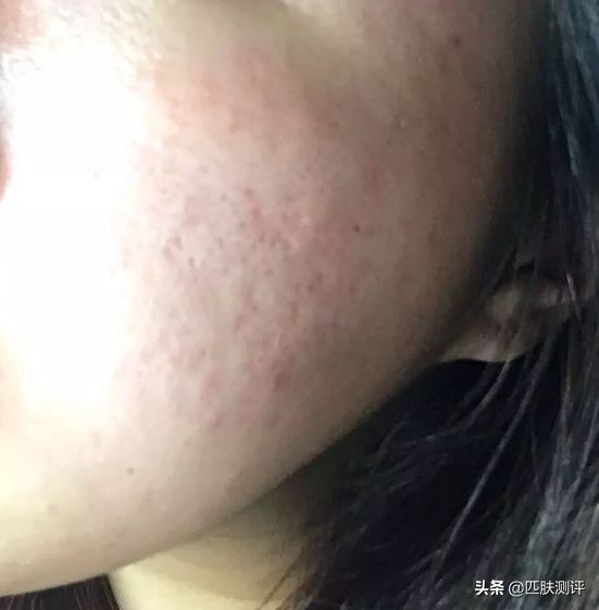 激光美容仪推荐,家用激光美容仪测评