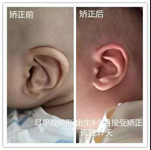 耳廓畸形高考生体检怎么办,二度耳廓畸形矫正方案