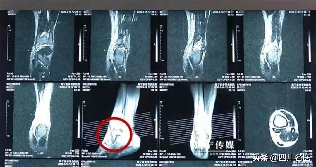 男子把脚崴了第二天又发现肿了,男子崴脚后没做这件小事