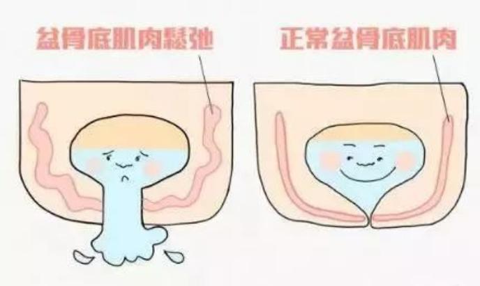 产妇刚生完孩子尿不出来,产妇生了孩子为什么排不出尿