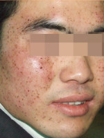 雀斑激光打了还会复发吗,雀斑一般用哪种激光最好