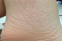 人工性荨麻疹是什么原因导致的,人工性荨麻疹是怎么造成的