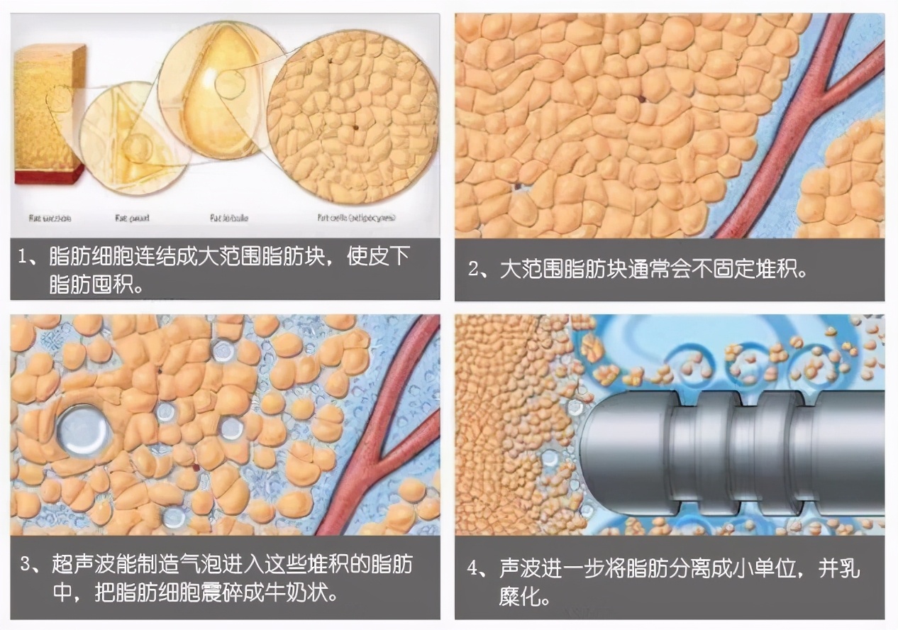 黄金微雕跟维密脂雕是一回事吗,黄金微雕和维密脂雕哪个好