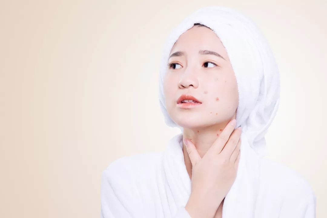 祛除粉刺闭口痘印的方法真实有效,祛除痘印闭口推荐什么产品