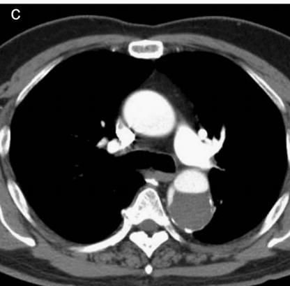 如何监测动脉夹层早期,动脉增强ct能查出主动脉夹层么