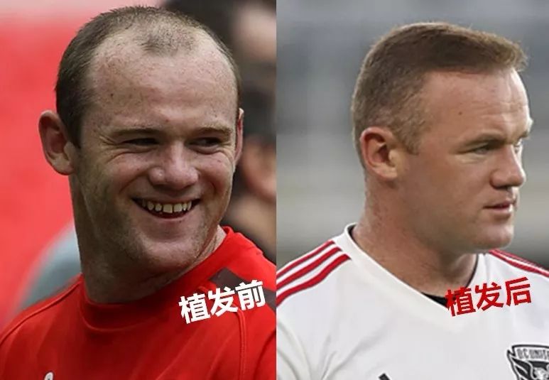 贝克汉姆自曝患上脱发症,贝克汉姆脱发照片