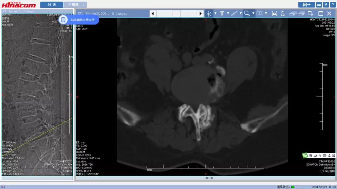 再也不用歪着身子走路了—区医院脊柱中心（骨二科）成功实施腰椎间盘摘除、椎间植骨融合钉棒内固定术