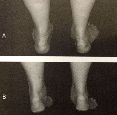 足踝损伤恢复方法,足踝损伤检查流程