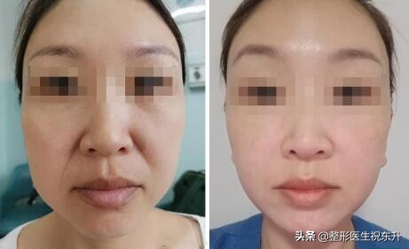 去除法令纹的最有效的方法是什么,去除法令纹最有效的方法是什么