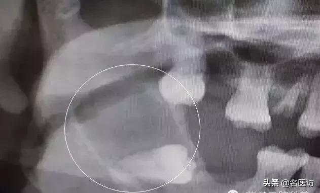 拔智齿有什么禁忌吗,拔智齿有什么禁忌