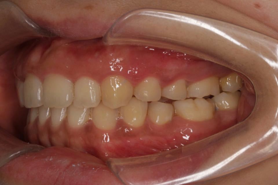 西安张军正畸医生如何,西安牙齿矫正案例