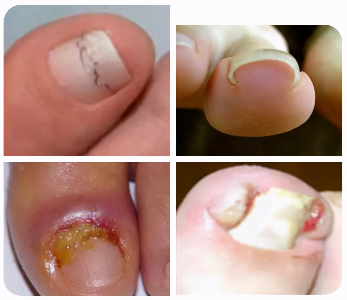 拔甲可以彻底治好嵌甲性甲沟炎吗,嵌甲甲沟炎拔了指甲还是红肿有脓