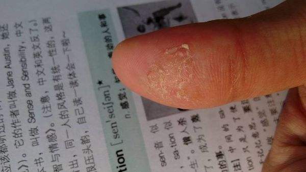手脚出水泡奇痒难忍教你简单一招,手脚起水泡奇痒无比什么办法最好