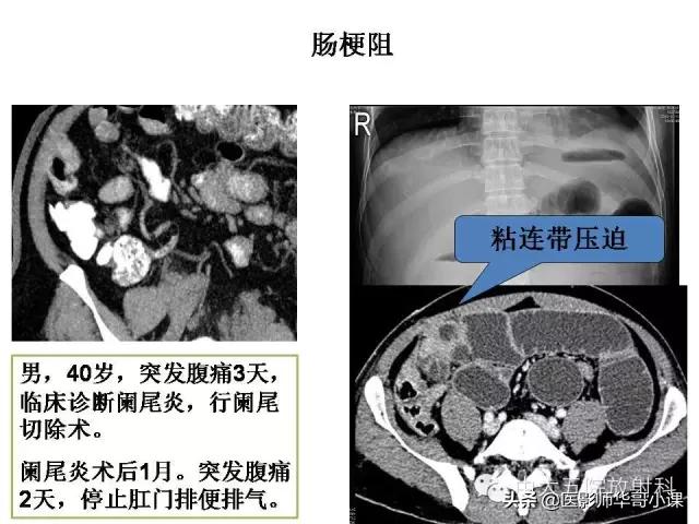 阑尾炎课件,阑尾炎的超声课件