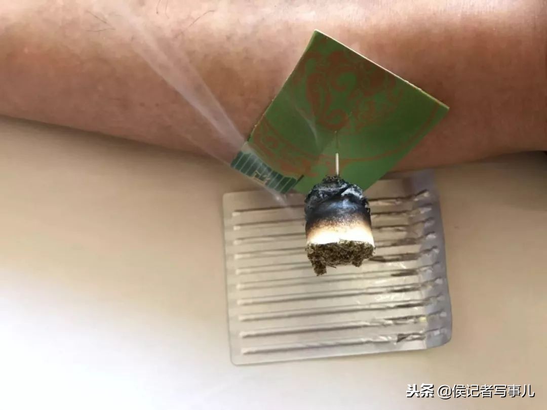 省中医院治疗面瘫最好的医生,面瘫是针灸一边或两侧治面瘫