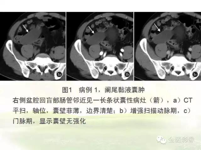 阑尾的ct解读与影像诊断技巧,阑尾影像学基础知识