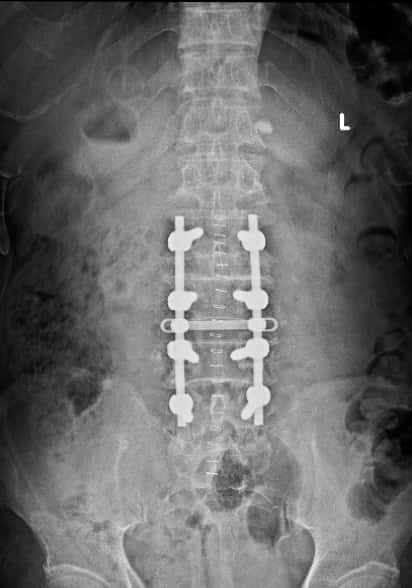 腰椎管狭窄症手术好么,腰椎管狭窄手术和保守治疗哪个好