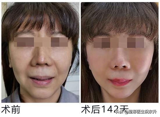 面部提升去法令纹,向上提拉脸能减轻法令纹吗