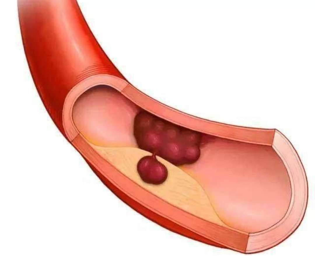 去除血栓最好的治疗办法,得了血栓怎么有效的去除