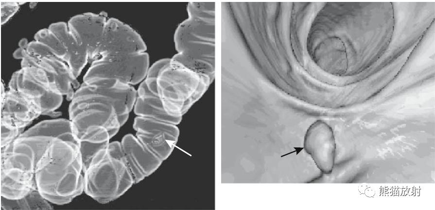 腹部影像图片大全,乙状直肠疼痛位置图片