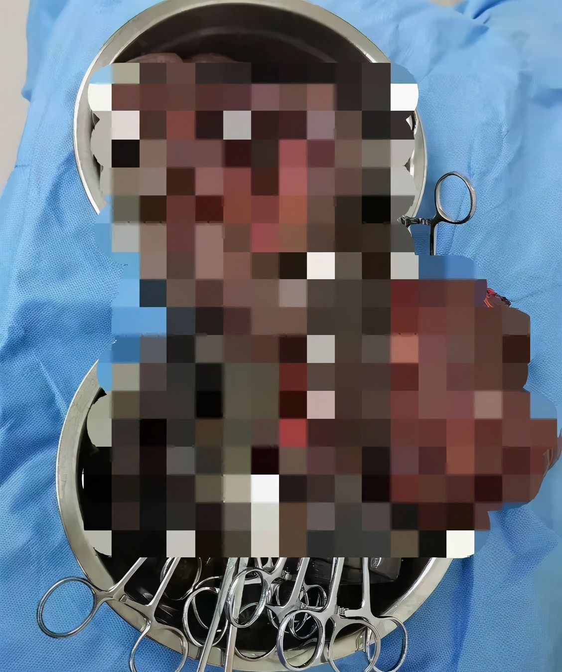 新冠心绞痛腹痛怎么办,突发严重胸痛警惕主动脉夹层