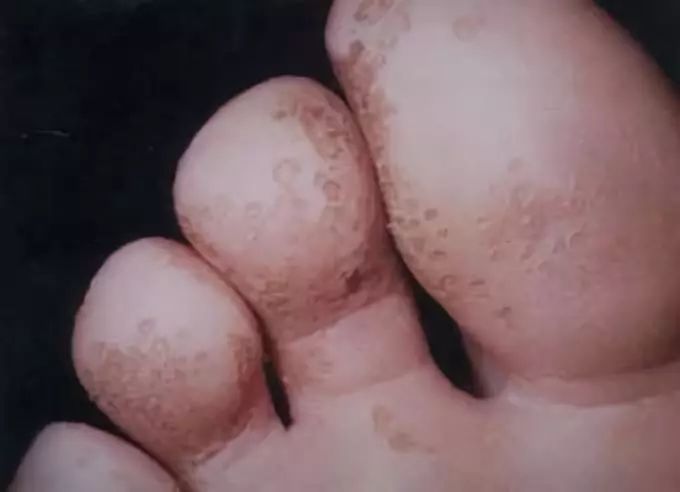 脚臭怎么洗才不臭,脚臭到底该怎么治永远不臭