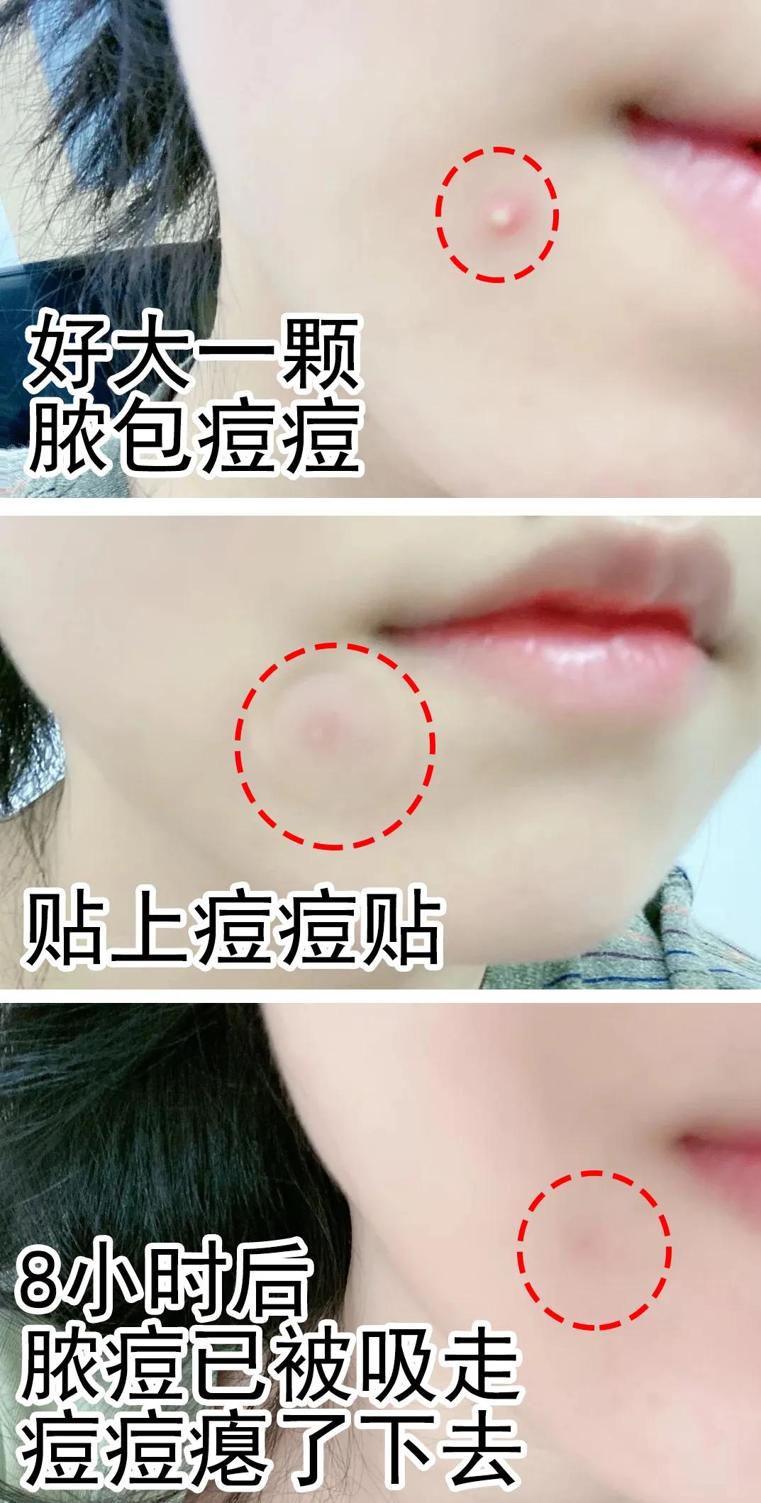 李佳琦推荐的痘痘贴,李佳琦推荐痘痘贴面膜