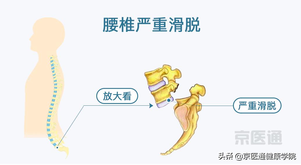 腰痛、腿痛是什么病？骨科医生用一块「羊蝎子」告诉你