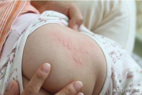 荨麻疹误以为慢性荨麻疹,小孩子荨麻疹科普知识