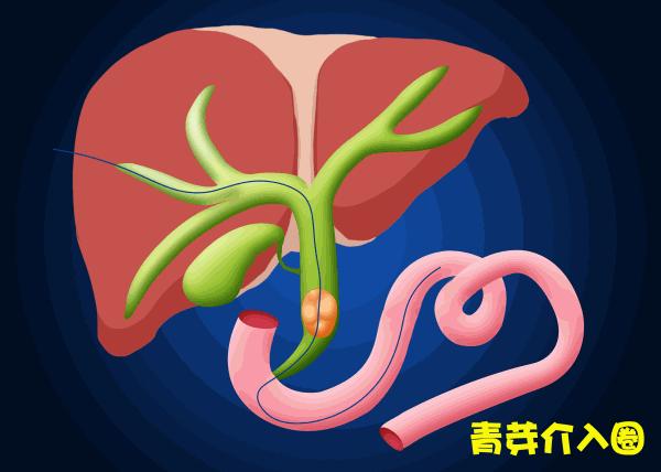 胆道阻塞眼睛发黄图片,胆管堵塞全身发黄中医治疗