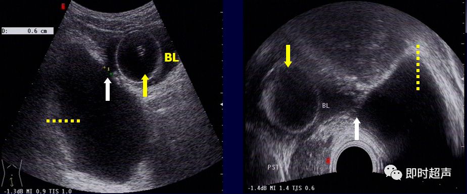 膀胱超声图解大全,膀胱超声解剖及常见病变超声表现