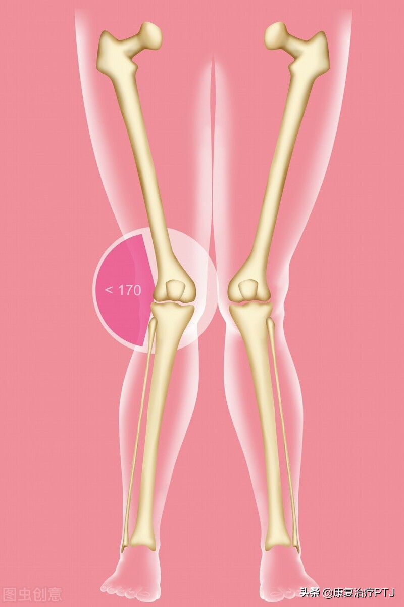 下肢力线异常表现,下肢力线有必要纠正吗