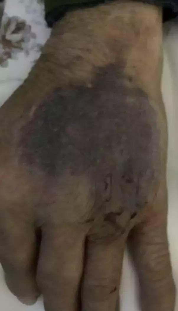 输液手背浮肿怎么消除,手背扎针输液为何手腕瘀血