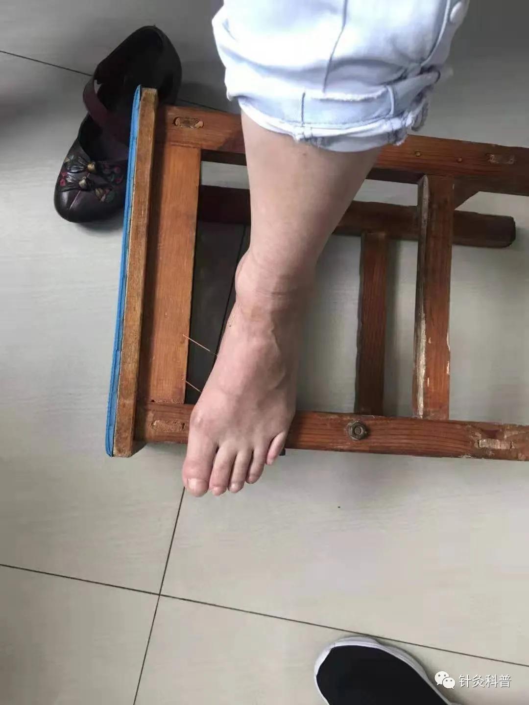 民间中医针灸治疗疑难杂症,中医疑难杂症针灸治疗成功