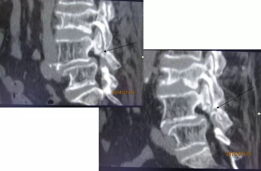 颈椎腰椎疾病ct及mri诊断,腰椎ct可以发现肠部病变吗