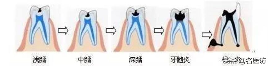 疫情期间牙痛怎么快速止疼,牙痛不是大病但痛起来要命