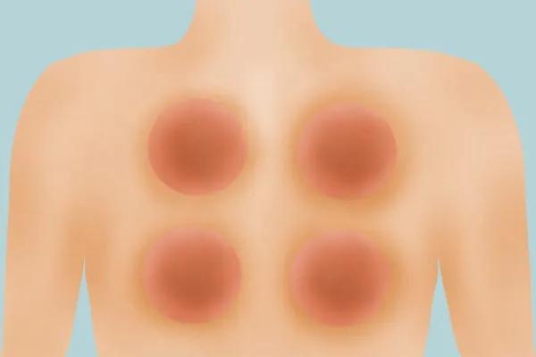 拔火罐的印子怎样快速去掉,拔火罐的印子怎样快速消除