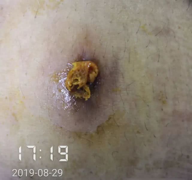 阑尾炎形成窦道的原因,阑尾炎一孔微创手术全过程