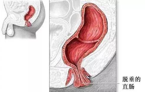 肛门潮湿是怎么回事吃啥中成药,肛门潮湿是怎么回事啊