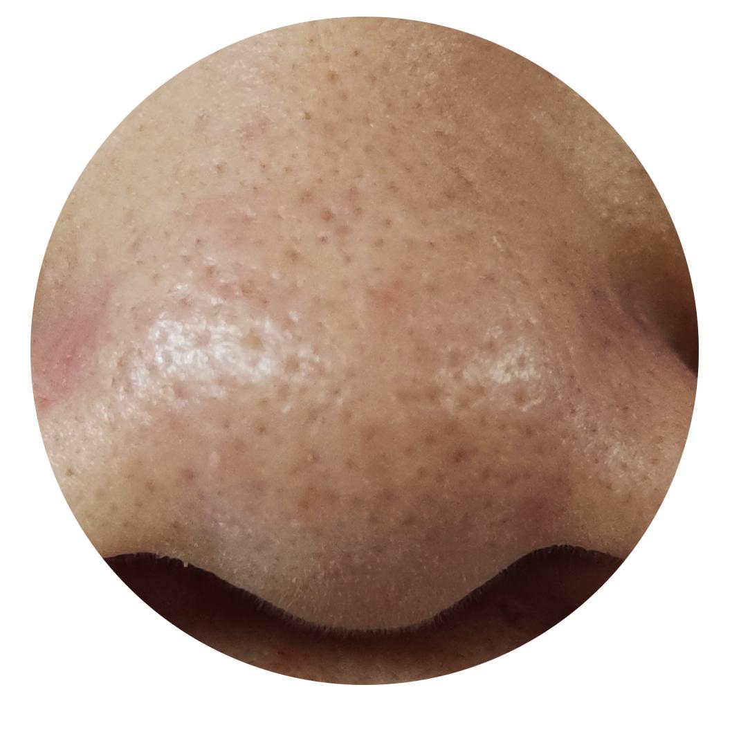 黑头毛孔粗大到底怎么治,黑头毛孔粗大有没有必要去改善