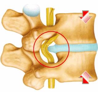 拍腰椎间盘突出视频,腰椎间盘突出拍的片子图片