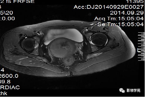 宫颈癌mri诊断,宫颈癌的mr扫描技术