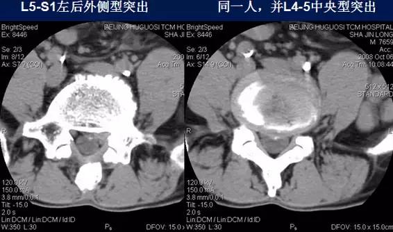 腰椎退行性变腰椎间盘轻度突出,椎间盘突出并膨出继发椎管狭窄