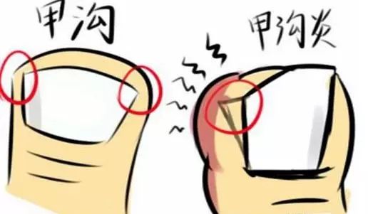 甲沟炎怎么办教你一招解决,甲沟炎怎么办用什么抗生素