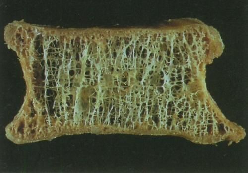 70岁老人腰骨折需要手术么,70岁老人腰椎骨折是保守还是手术