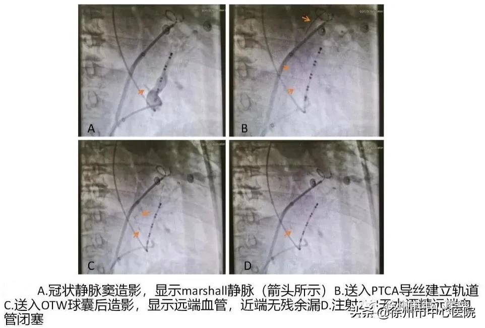 多年饮酒房颤戒酒后几年能恢复,多年房颤中医能治吗